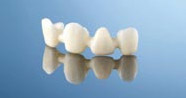 Procera® Bridge Alumina