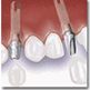 the Immediate implant