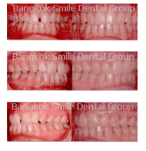 Invisalign Patient Bangkok Thailand tooth laser implant