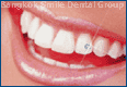 whitening tooth laser implant dental work clinic thailand bangkok dentist teeth