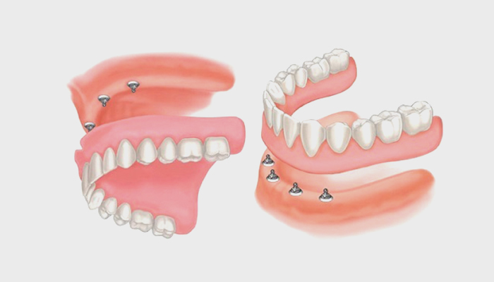 Implant Over-Dentures with 4 Dental Implants