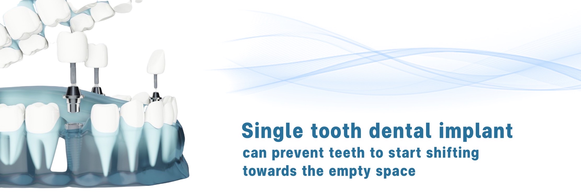 More about dental implants