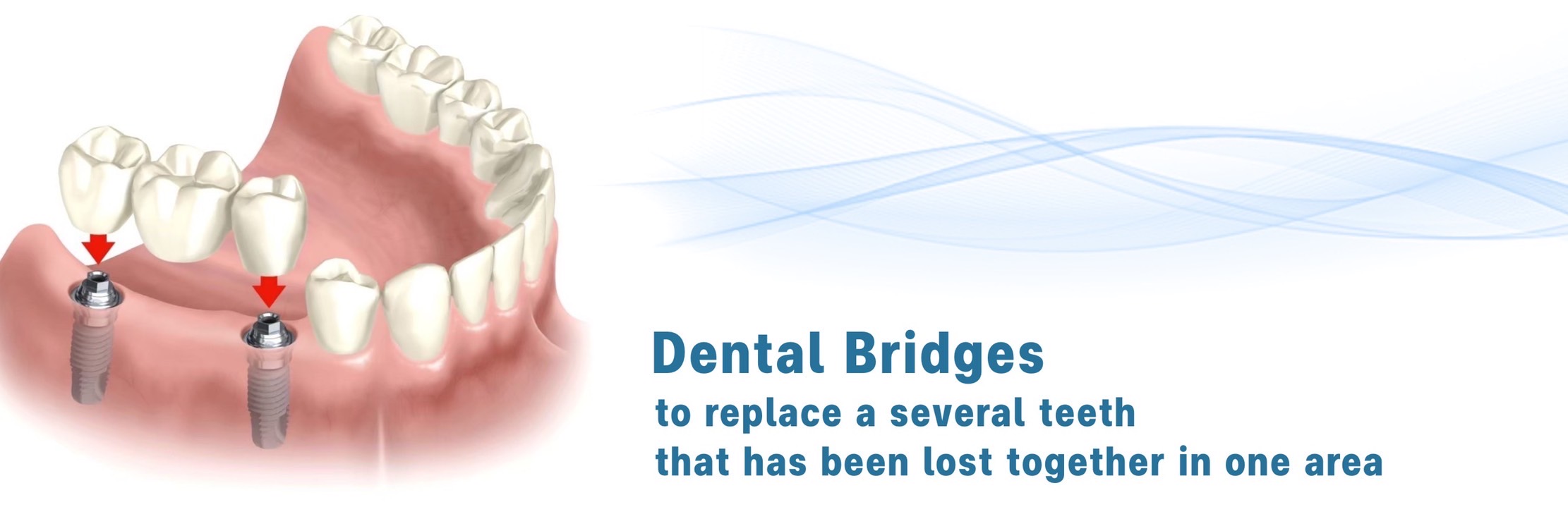 More about dental implants