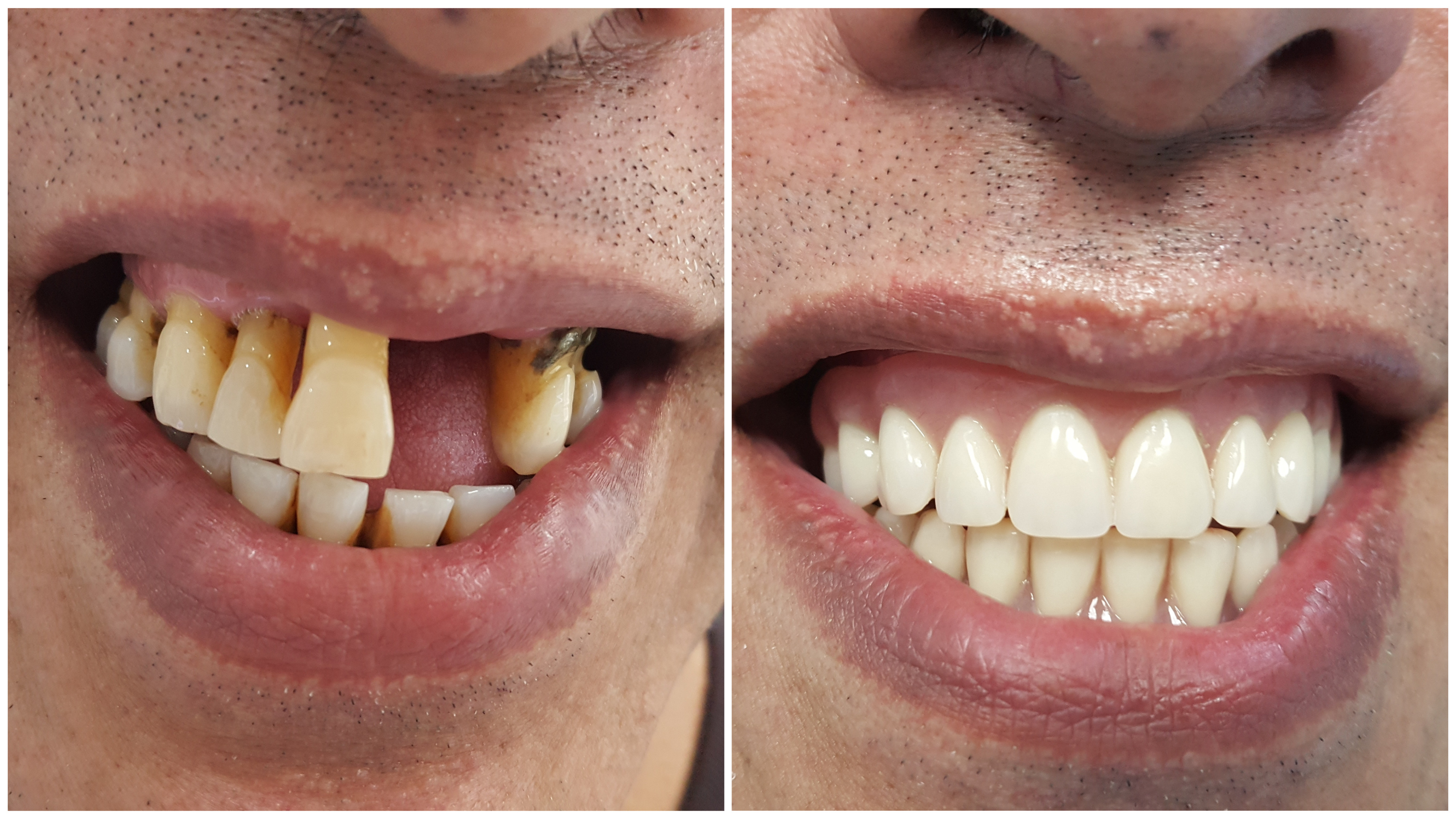 Dental Implants, Teeth Implants in Thailand Bangkok's Top Dental.