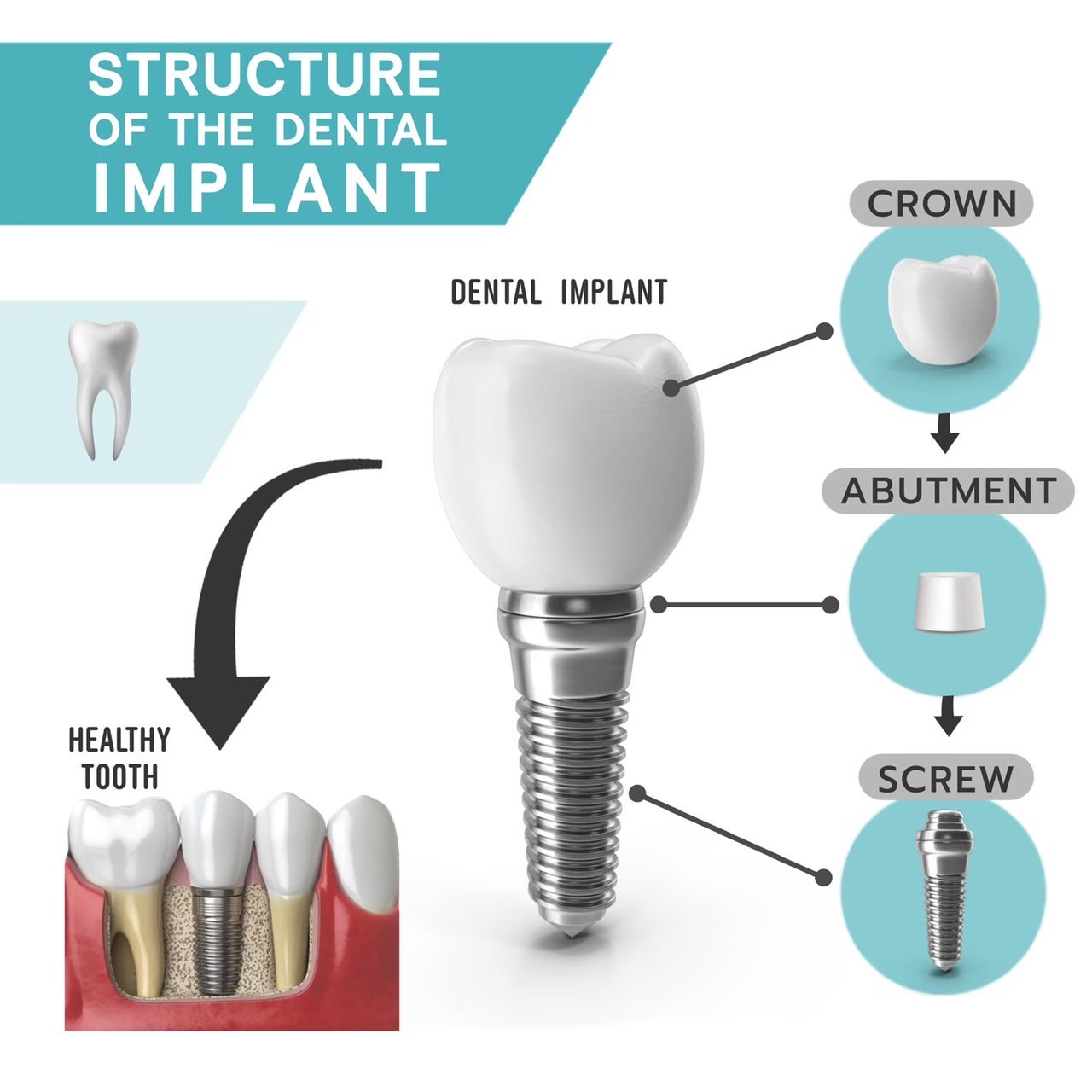 More about dental implants