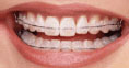 Fixed Metal braces