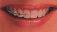 Fixed Metal braces