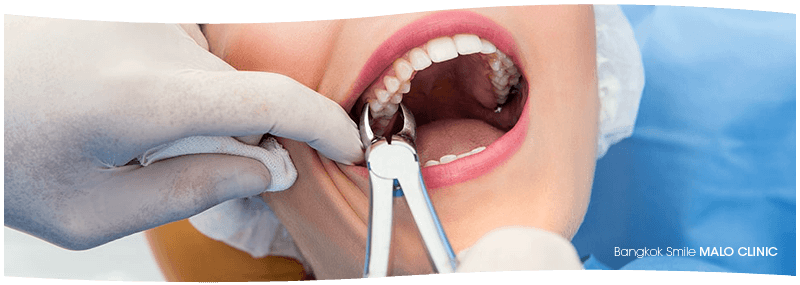 Can You Smoke After Tooth Extraction With Stitches Dental Surgery Bangkok Dentist Bangkok By Smile Dental Clinic In Thailand