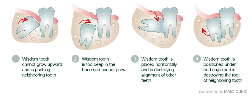 In wisdom tooth sideways coming Is it