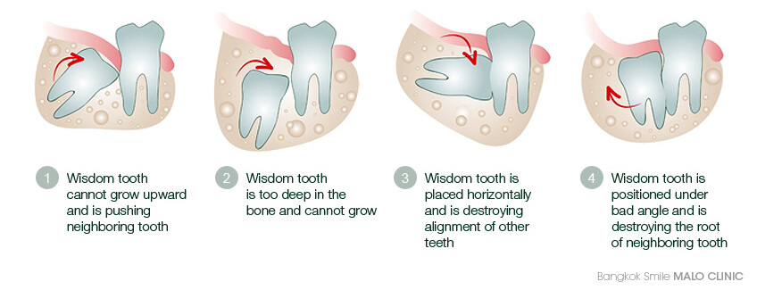 Growing out sideways tooth Why Is