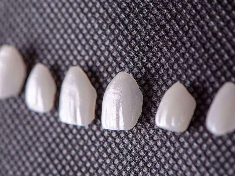 Dental Veneers Thailand Bangkok Smile Dental MALO DENTAL