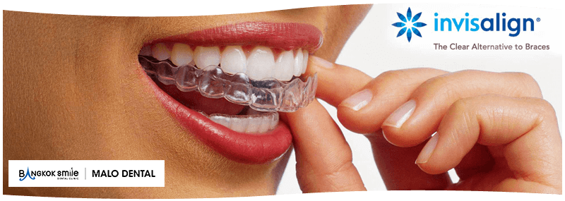 Invisalign™ Treatment