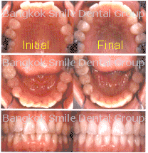 invisalign teeth crooked crowding overbite smile does bite tooth dental bangkok patient tell deep bangkoksmiledental treatment ortho gave implant removed