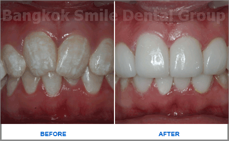 2 Emax Veneers