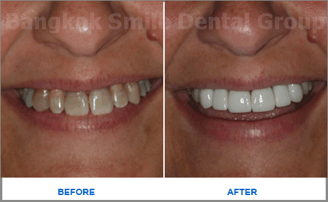 2 Emax Veneers