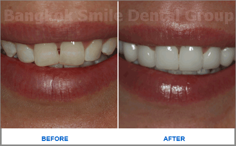 2 Emax Veneers