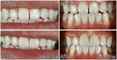 2 Emax Veneers