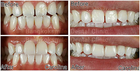 2 Emax Veneers