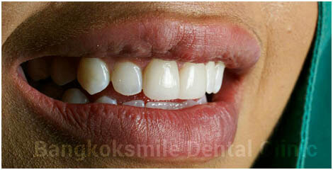 2 Emax Veneers