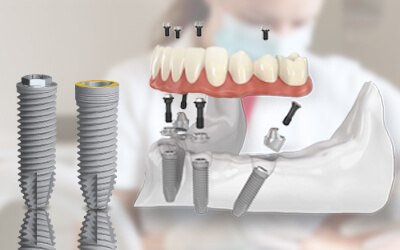 Fast Treatments - Dental Implants & Dr. Paulo Malo’s All-on-4™ Protocol