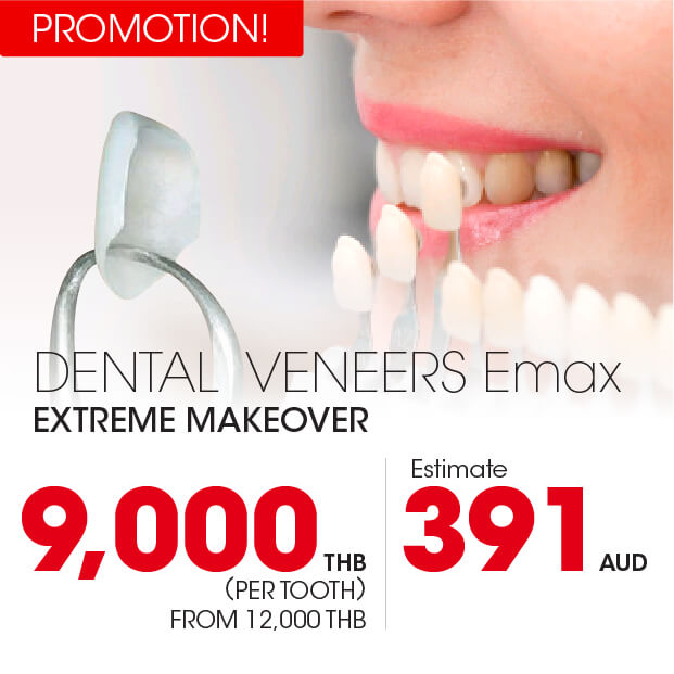 Dental Veneers