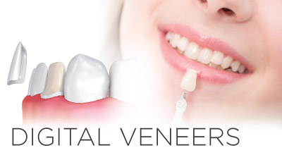 Digital Veneers