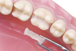 Dental Fillings