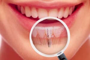 Dental Implants