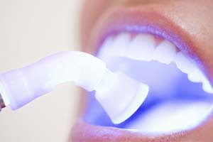 Laser Teeth Whitening