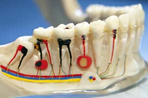 Root Canal Treatment