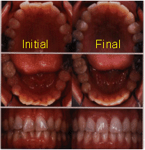 Invisalign Patient Bangkok Thailand tooth laser implant