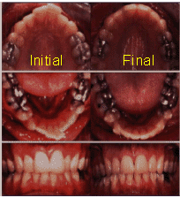 Invisalign Patient Bangkok Thailand dentist teeth whitening