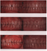 Invisalign Patient Bangkok Thailand tooth laser implant