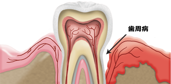 Periodontal