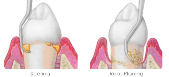 Periodontal