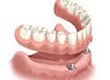 Overdenture