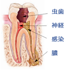 Root cannal