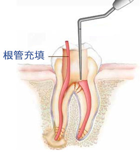 Root cannal