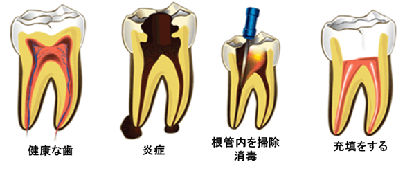 Root cannal