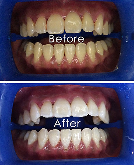 Tooth Whitening