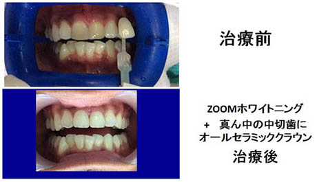 Tooth Whitening