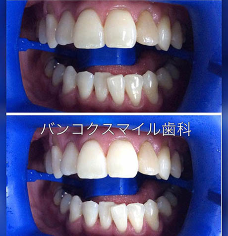 Tooth Whitening