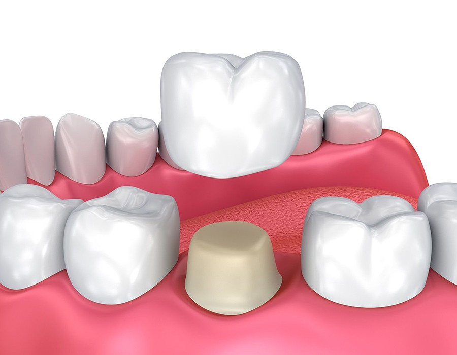 Dental Crowns & Bridges