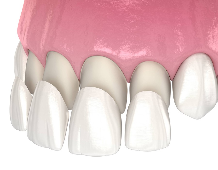 Dental Veneers