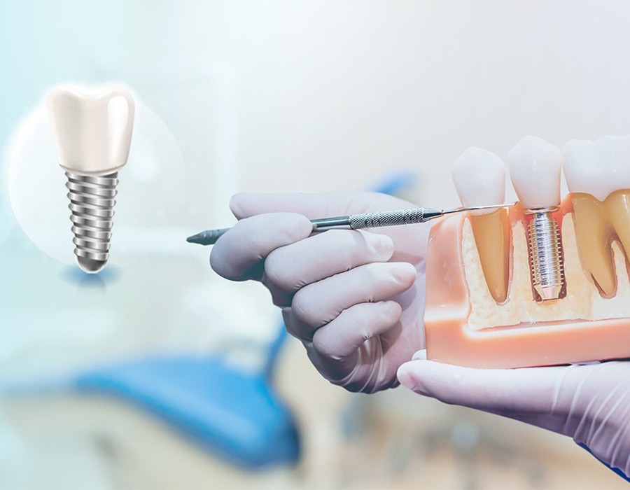 Immediate Dental Implants