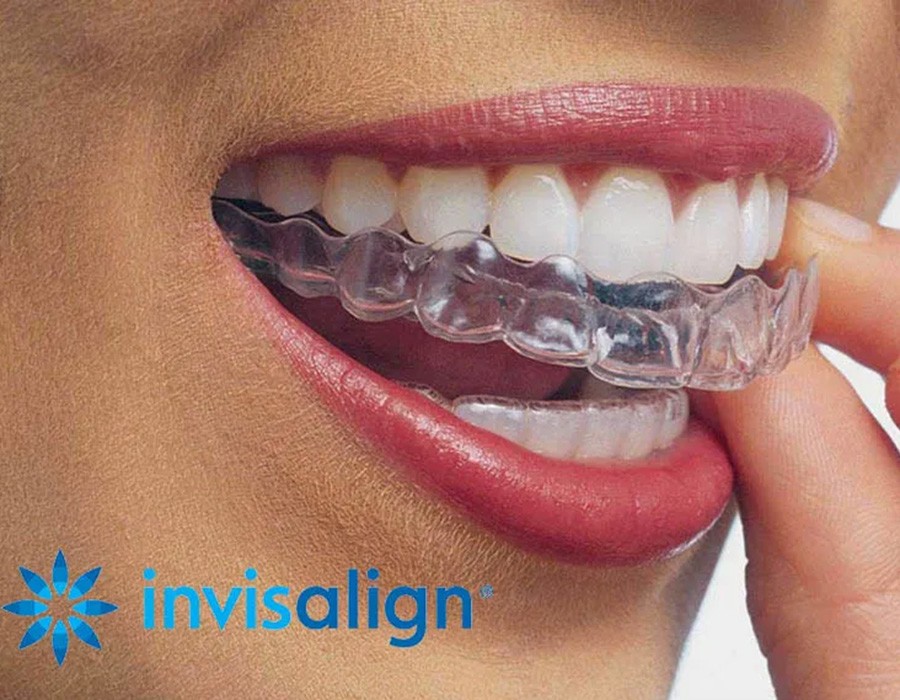 Invisalign