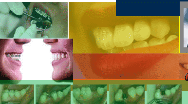 Dental clinic in Bangkok - Thailand dentist teeth whitening tooth laser implant cosmetic dental veneer crown invisalign
