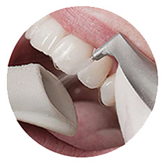 tooth spa airflow การขจัดคราบฝังแน่นบนผิวฟัน