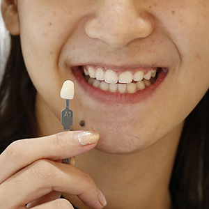 Crystal Smile Whitening ฟอกสีฟันด้วยเทคโนโลยีที่ได้รับความนิยม