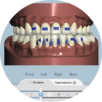 จัดฟันแบบใส Crystal smile